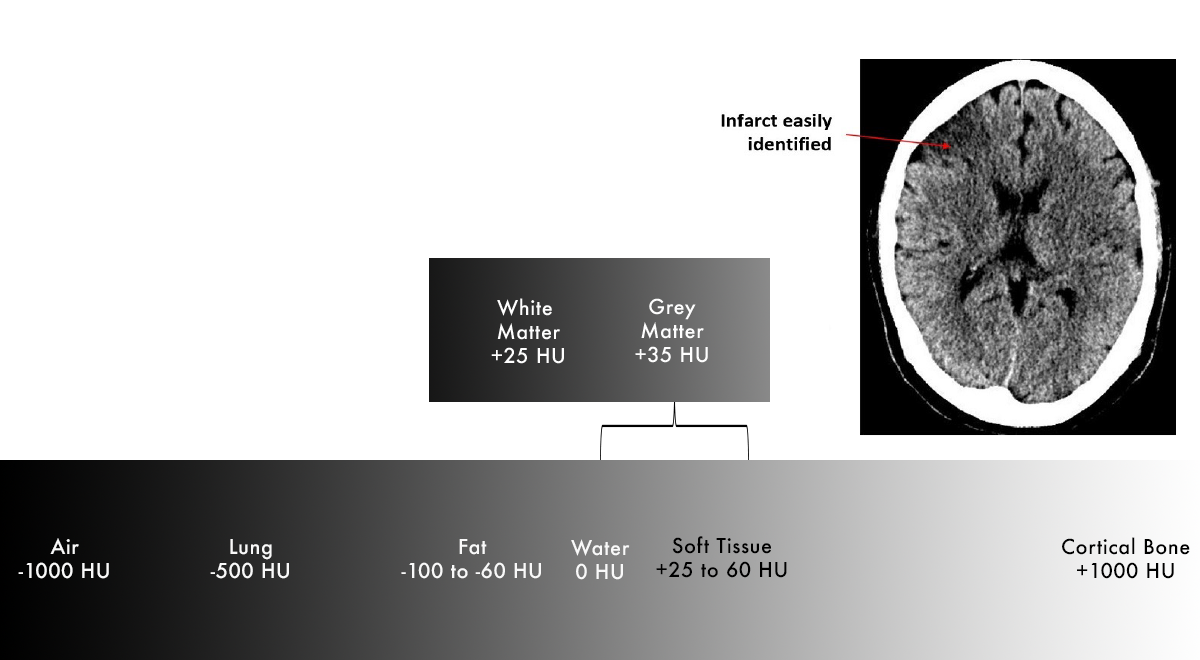 Hounsfield Units Brain Window